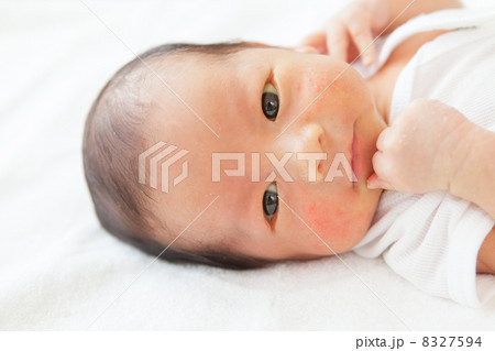 新生児にきび 新生児ニキビの写真素材