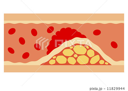 脂質異常症のイラスト素材