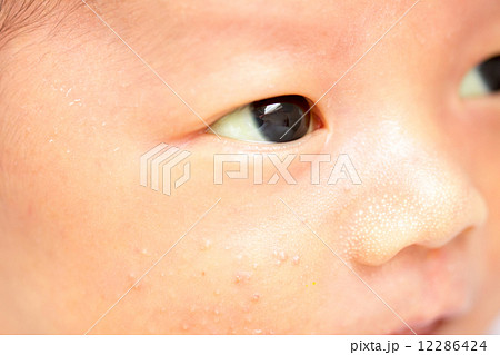黄疸 赤ちゃんの写真素材