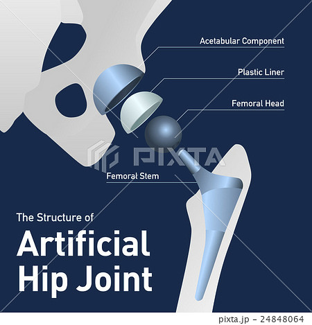 人工股関節のイラスト素材