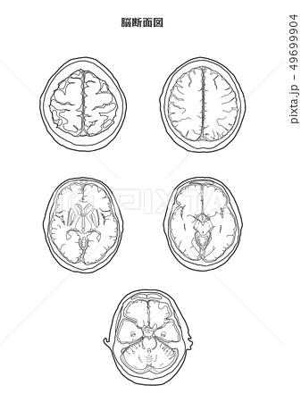 無料印刷可能 脳 Ct イラスト サマロンデ