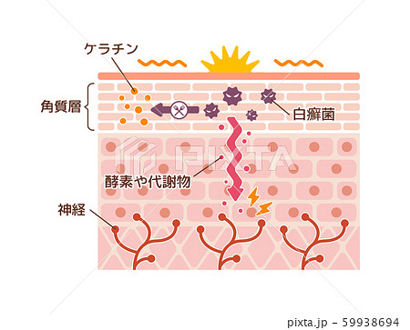 水虫のイラスト素材