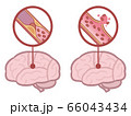 脳梗塞のイラスト素材