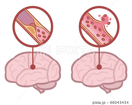 脳梗塞のイラスト素材