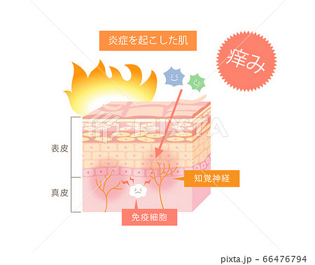 皮膚炎のイラスト素材