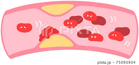 動脈硬化のイラスト素材