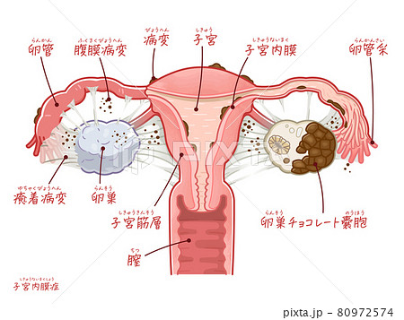 女性 子宮 断面図 断面のイラスト素材 - PIXTA