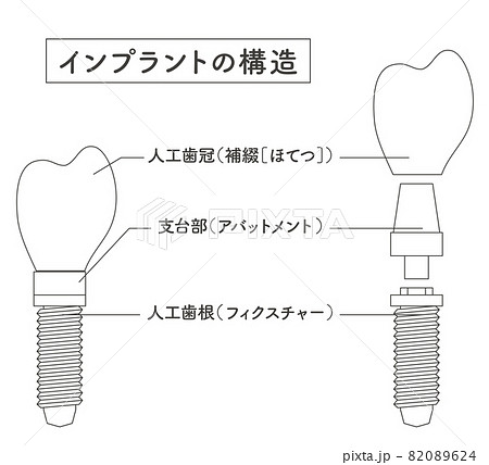 インプラントのイラスト素材