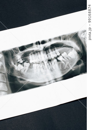 デンタルエックス線写真 デンタル 歯科 骨格 X線の写真素材 - PIXTA
